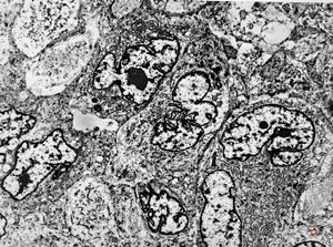 M,51y. | scrotal myosarcoma M,51y. | scrotal myosarcoma